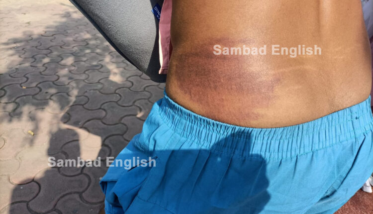 Youth alleges third degree torture by Hatibari police in Sundargarh