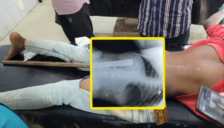 Doctors remove 1.5 ft crowbar from minor’s body in Odisha’s MKCGMCH